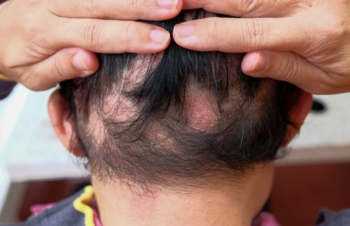 Reclaim Your Hair: Effective Strategies to Reverse Traction Alopecia Naturally